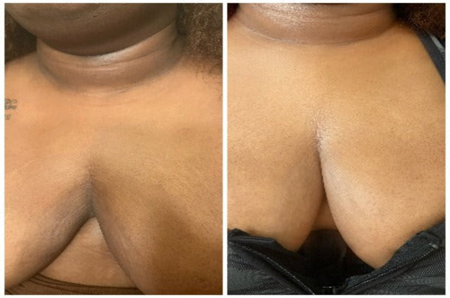 Exfoliating Bundle